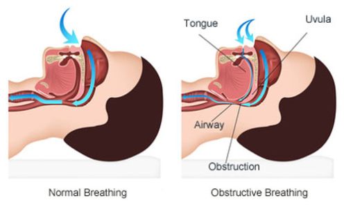 stop-breathing-while-sleeping-sleep-apnea-guide