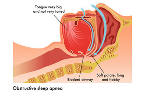 Obstructive Sleep Apnea